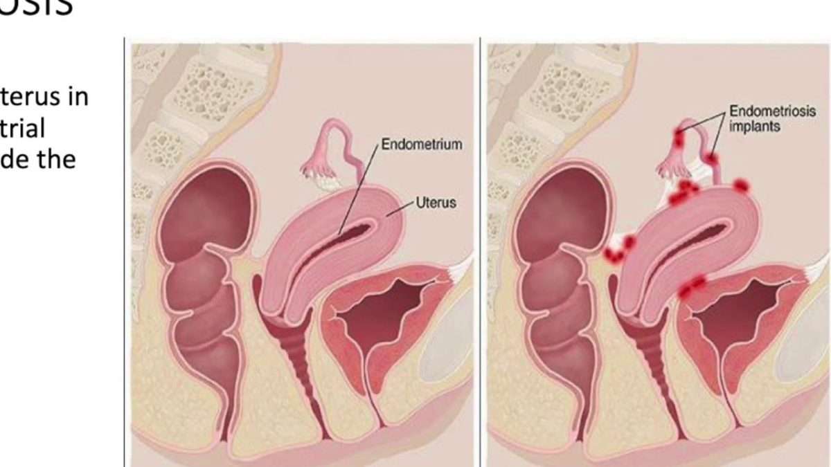 Organs Shifting After Hysterectomy