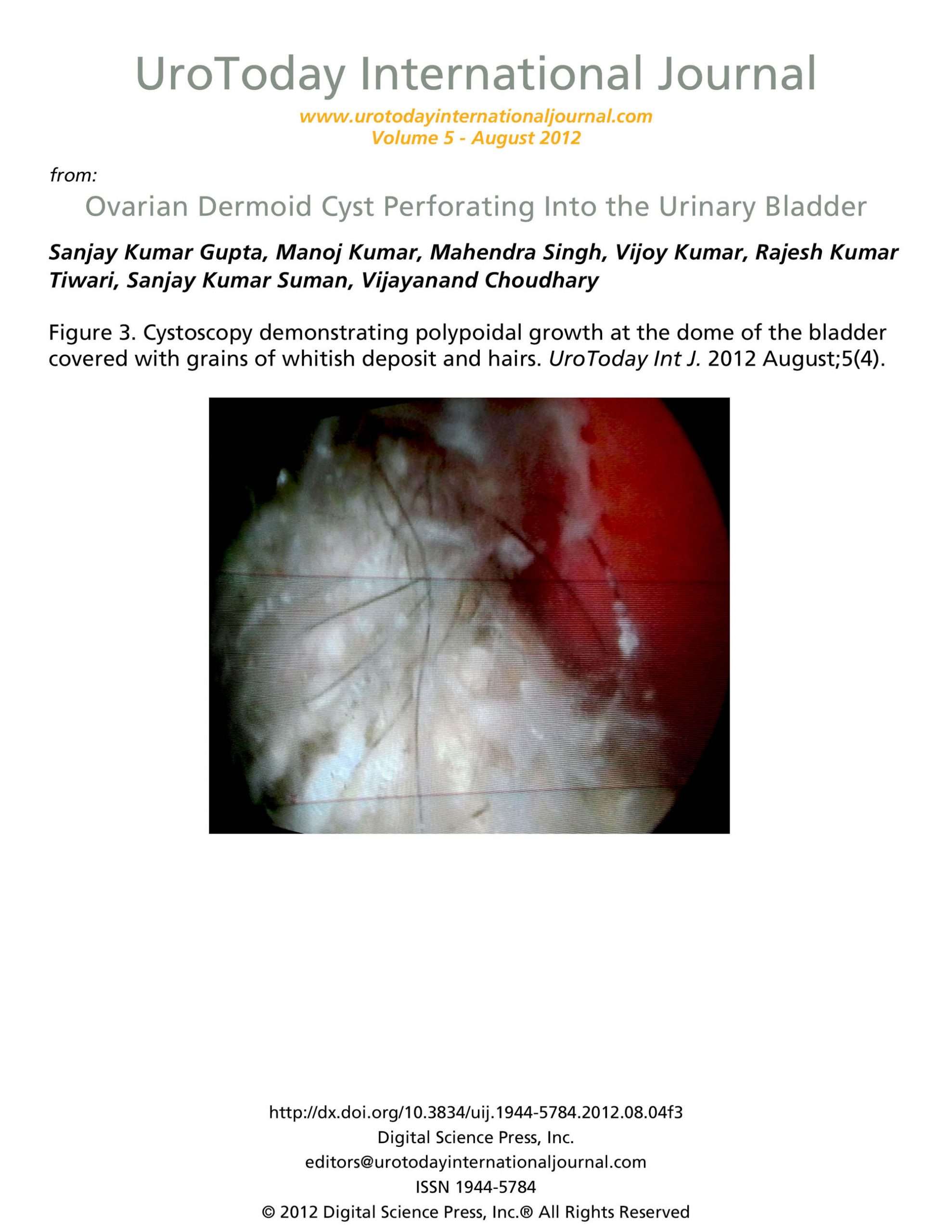 Ovarian Dermoid Cyst Perforating Into the Urinary Bladder