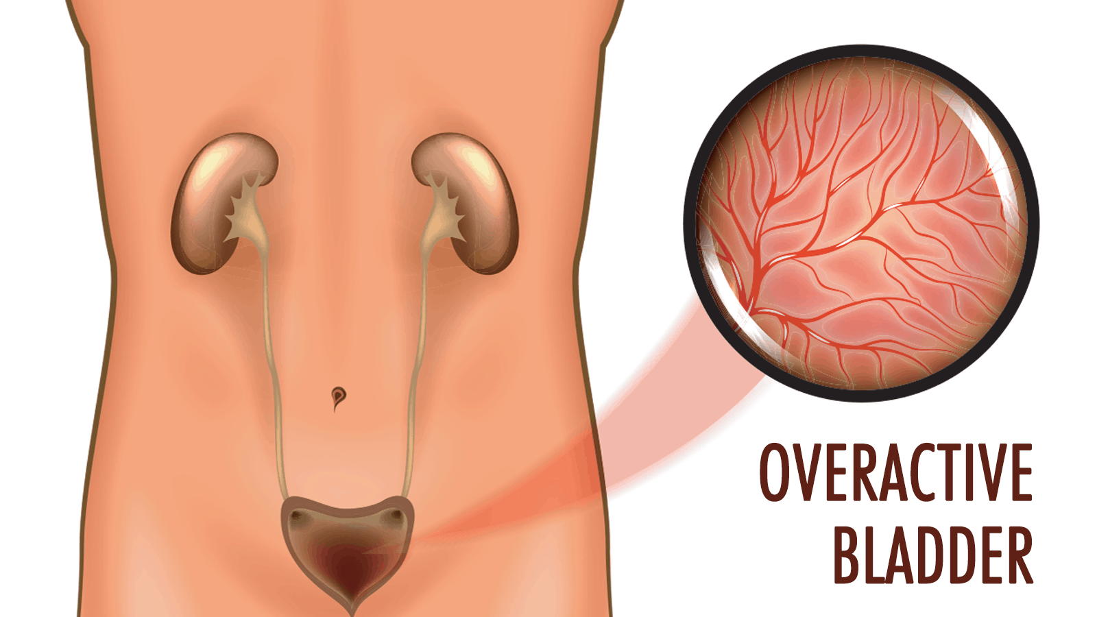 Overactive bladder, cause of enlarged prostate in men ...