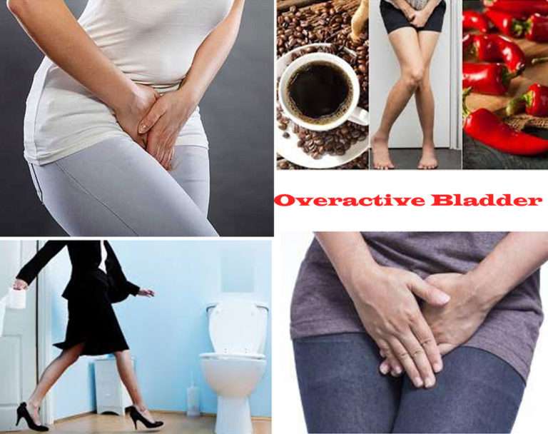 Overactive Bladder: Causes, Symptoms, Diagnosis and ...