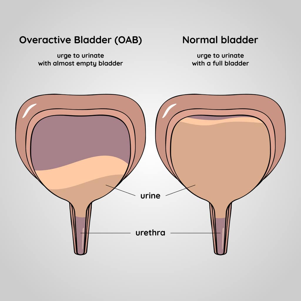 Overactive Bladder Doesn