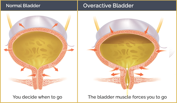 Overactive Bladder FAQ