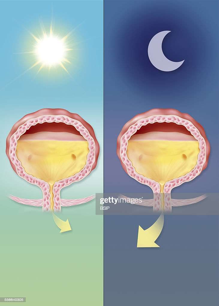 Overactive Bladder, Illustration of nocturia, the ...