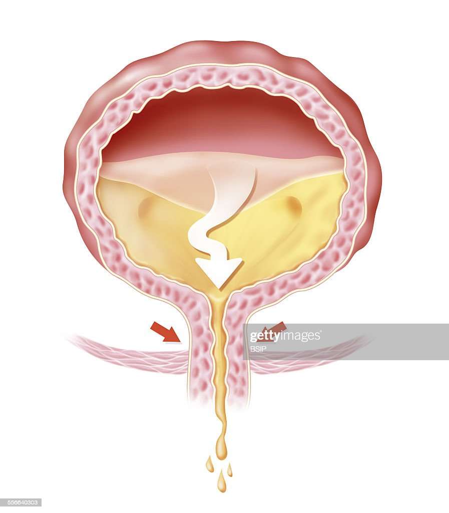 Overactive Bladder, Illustration of urinary incontinence. The pelvic ...