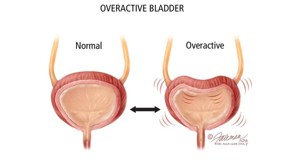 Overactive Bladder (OAB): Causes, Diagnosis &  Treatment ...