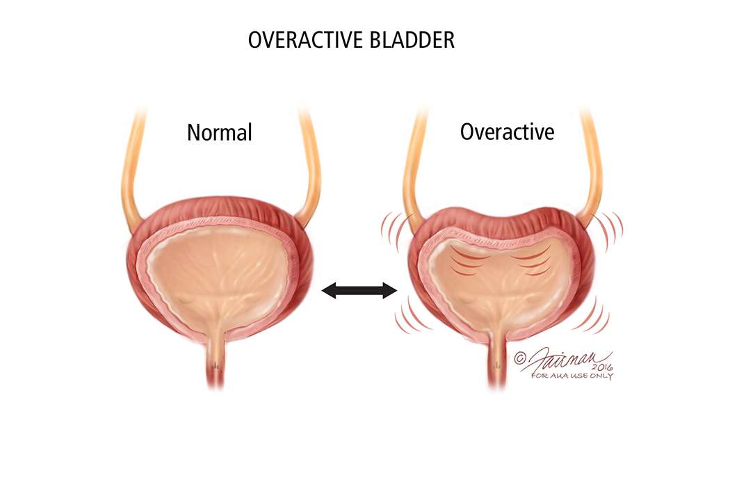 Overactive Bladder (OAB): Symptoms, Diagnosis &  Treatment ...