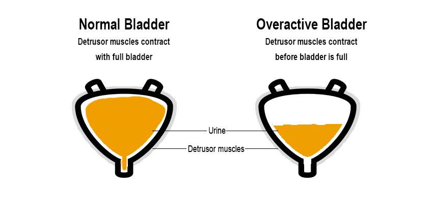 Overactive Bladder treatment