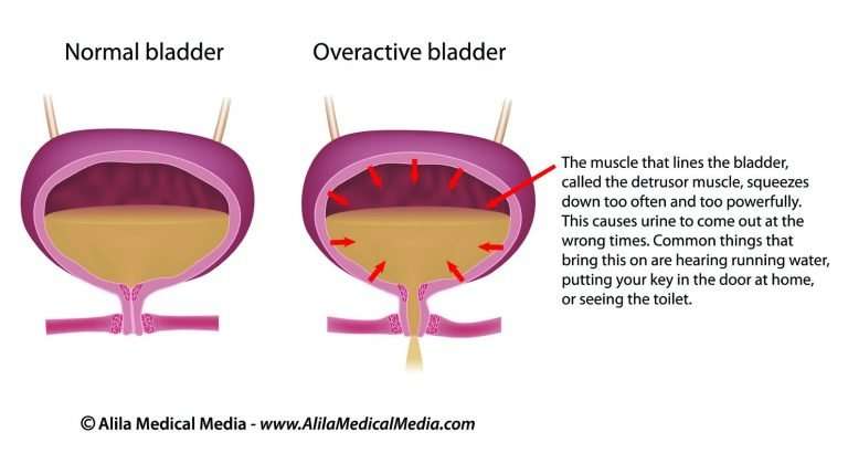 Overactive Bladder &  Urge Urinary Incontinence