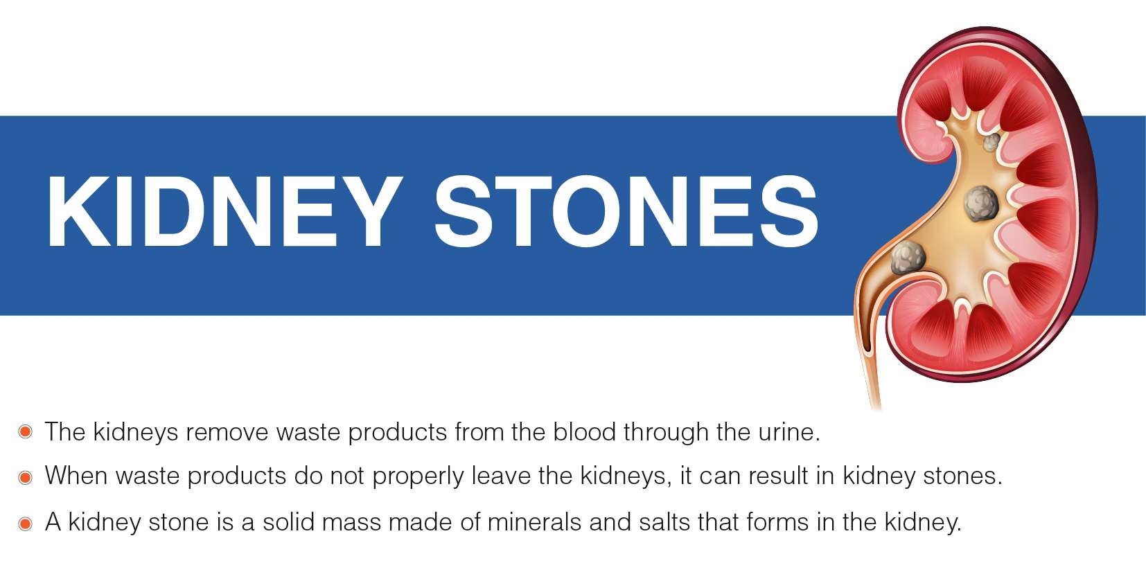 Overview of Kidney Stones