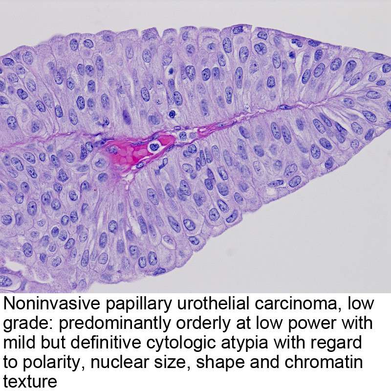 Papillary urothelial carcinoma bladder icd 10
