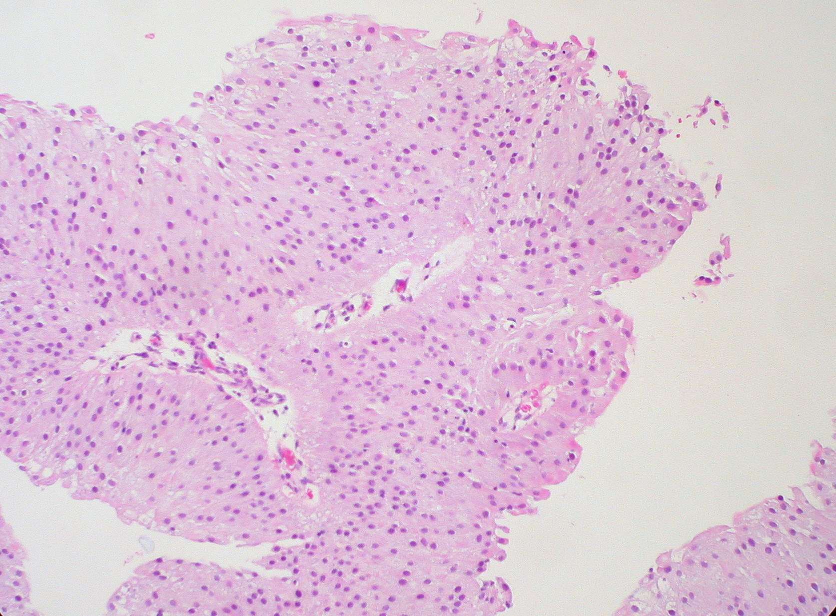 Papillary urothelial carcinoma invasive icd 10