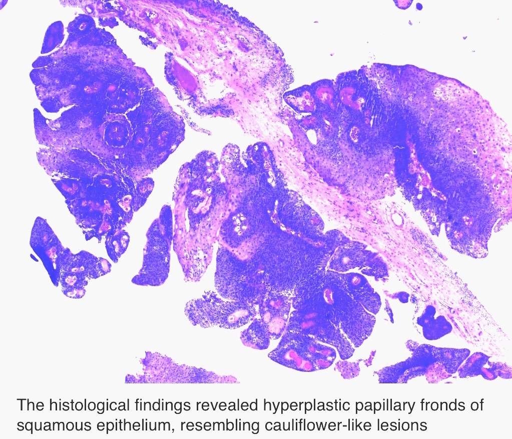 Papillary urothelial hyperplasia bladder icd 10
