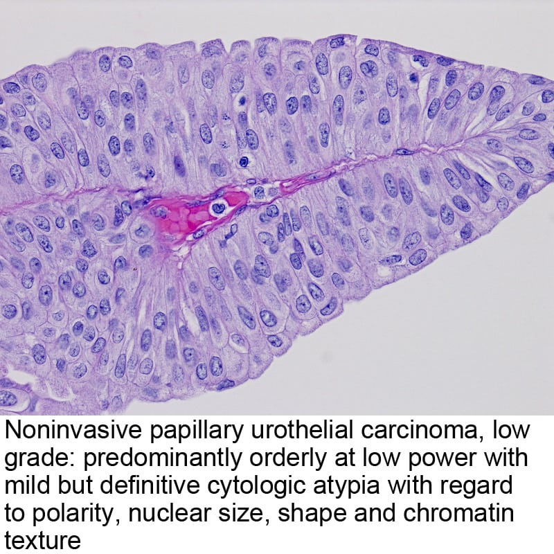 Papillary urothelial neoplasm icd 10. Papillary urothelial carcinoma ...