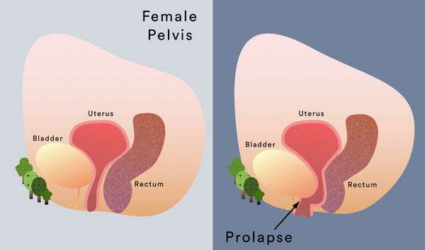 Pelvic Organ Prolapse: How to Stop the POP  the ICONIC
