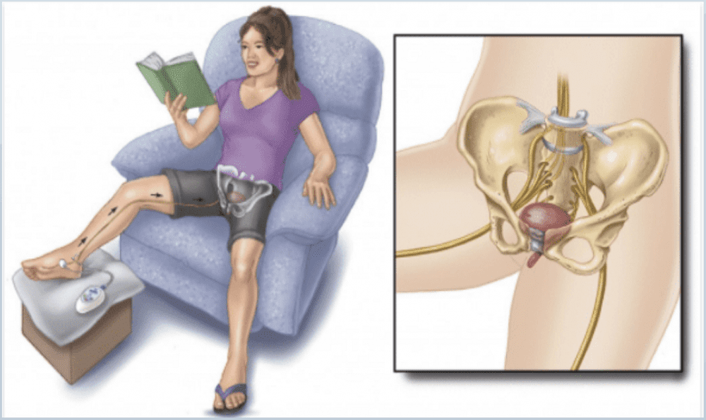 Percutaneous Tibial Nerve Stimulation (PTNS): What You Need To Know ...