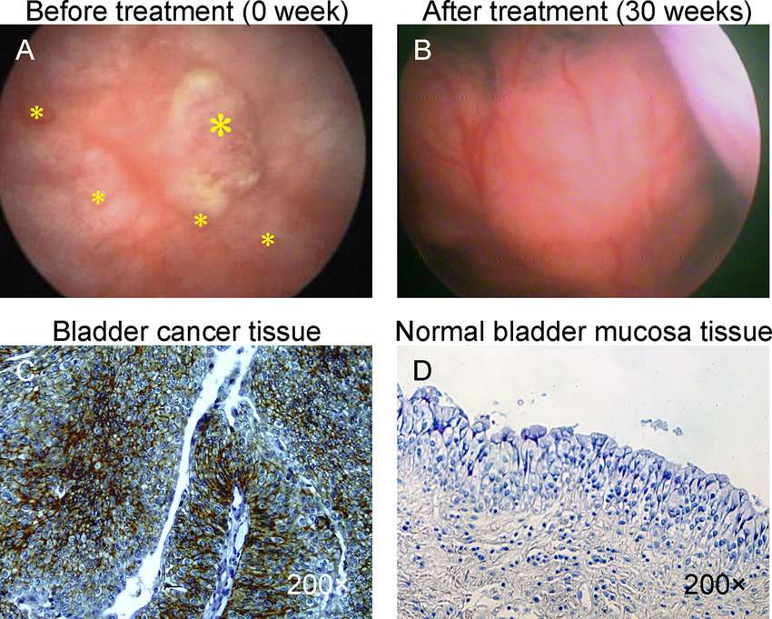 Photograph of bladder cancer with intravescical ...