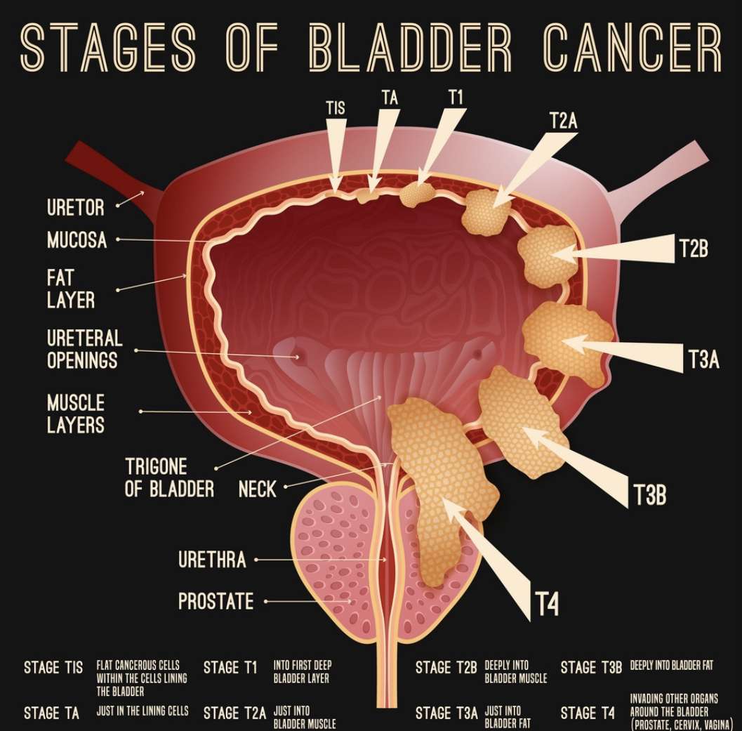 Pictures Of Bladder Cancer Tumors