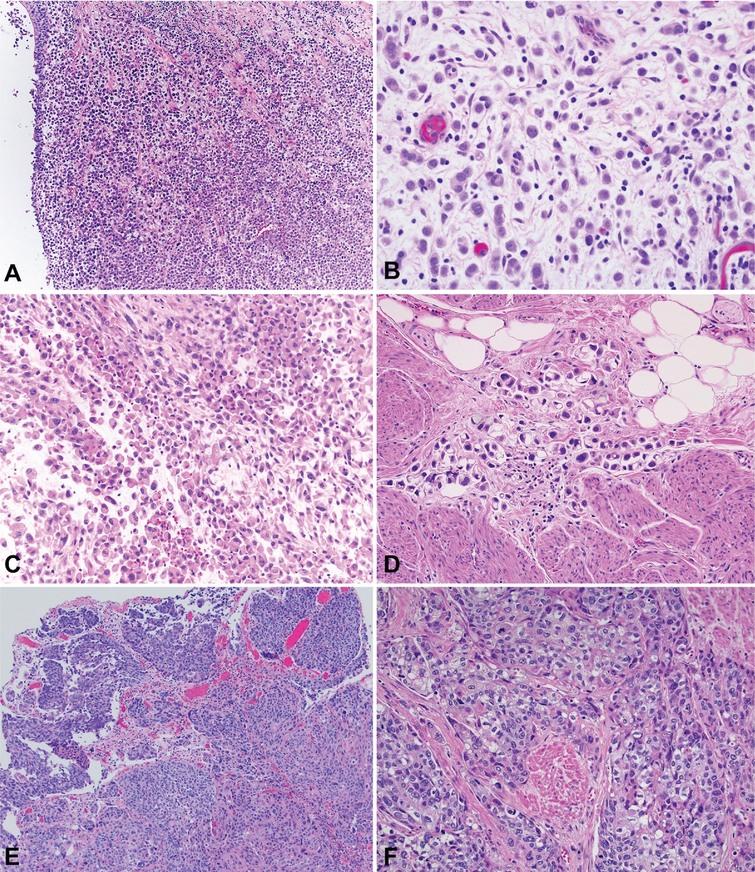 Plasmacytoid Urothelial Carcinoma: Response to Chemotherapy and ...