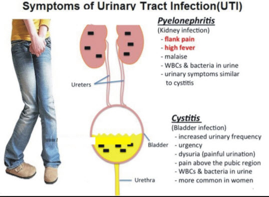 Powerful Antibiotic For Urinary Tract Infection Hits Market