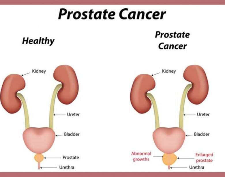 Prostate Cancer: Things to Know