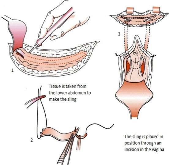 Pubovaginal sling (rectus fascial sling) â Urology Associates