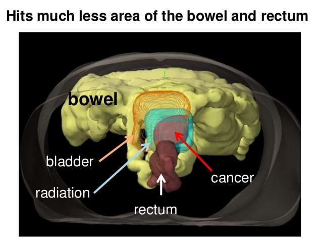 Radiation for the Treatment of Bladder Cancer