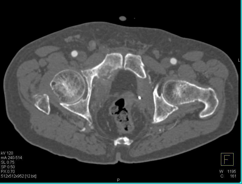 Recurrent Bladder Cancer with Bone Involvement and Lung ...