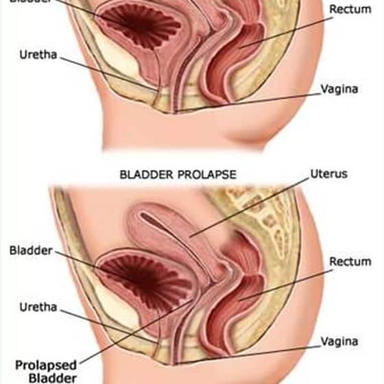 Remedies for a Prolapsed Bladder