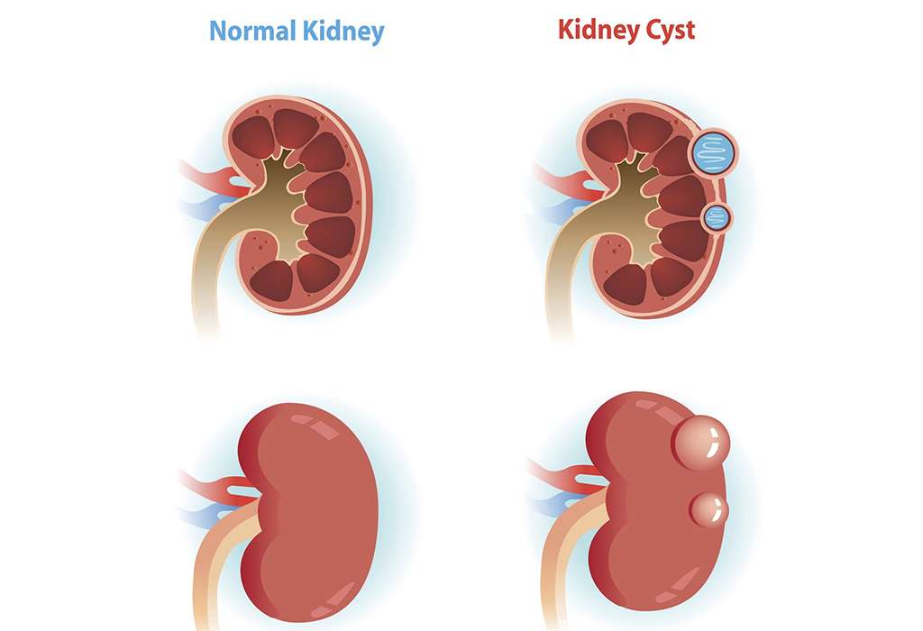 Renal Cysts