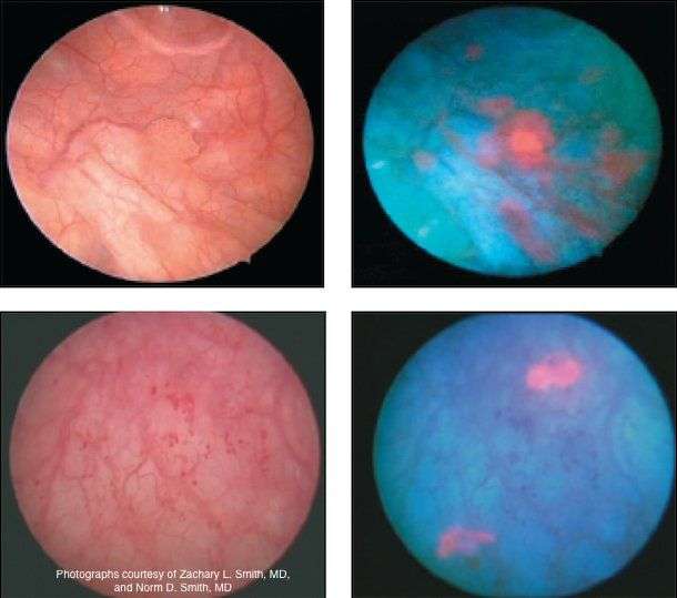 Role of blue light cystoscopy to detect bladder cancer