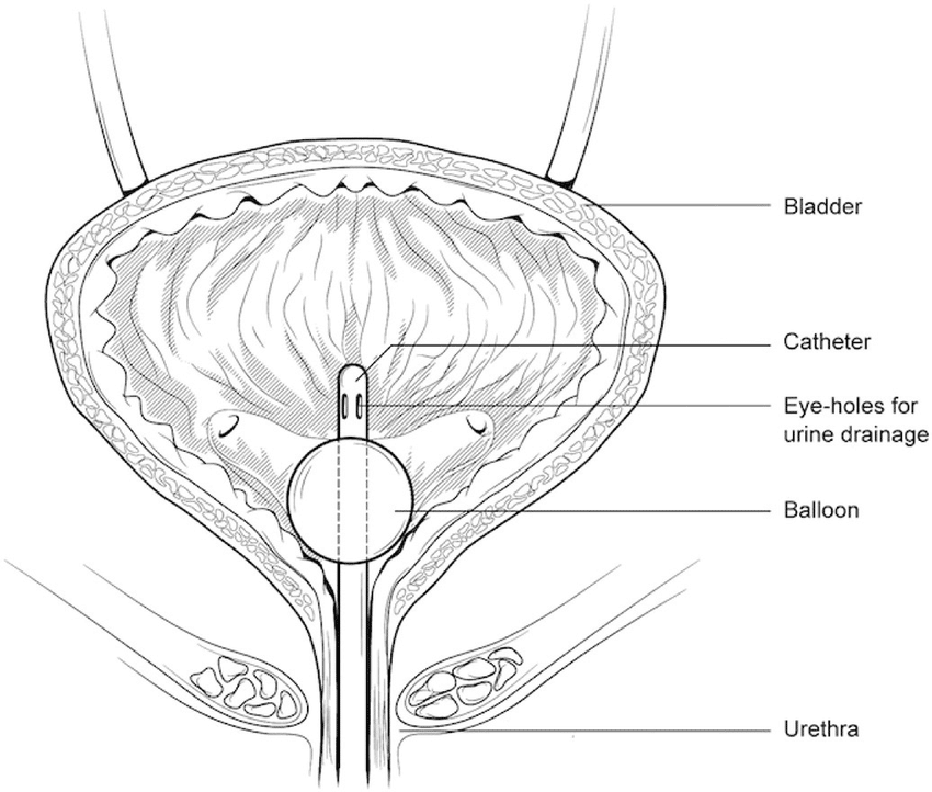 Schematic of a catheterized urinary bladder, showing the Foley catheter ...