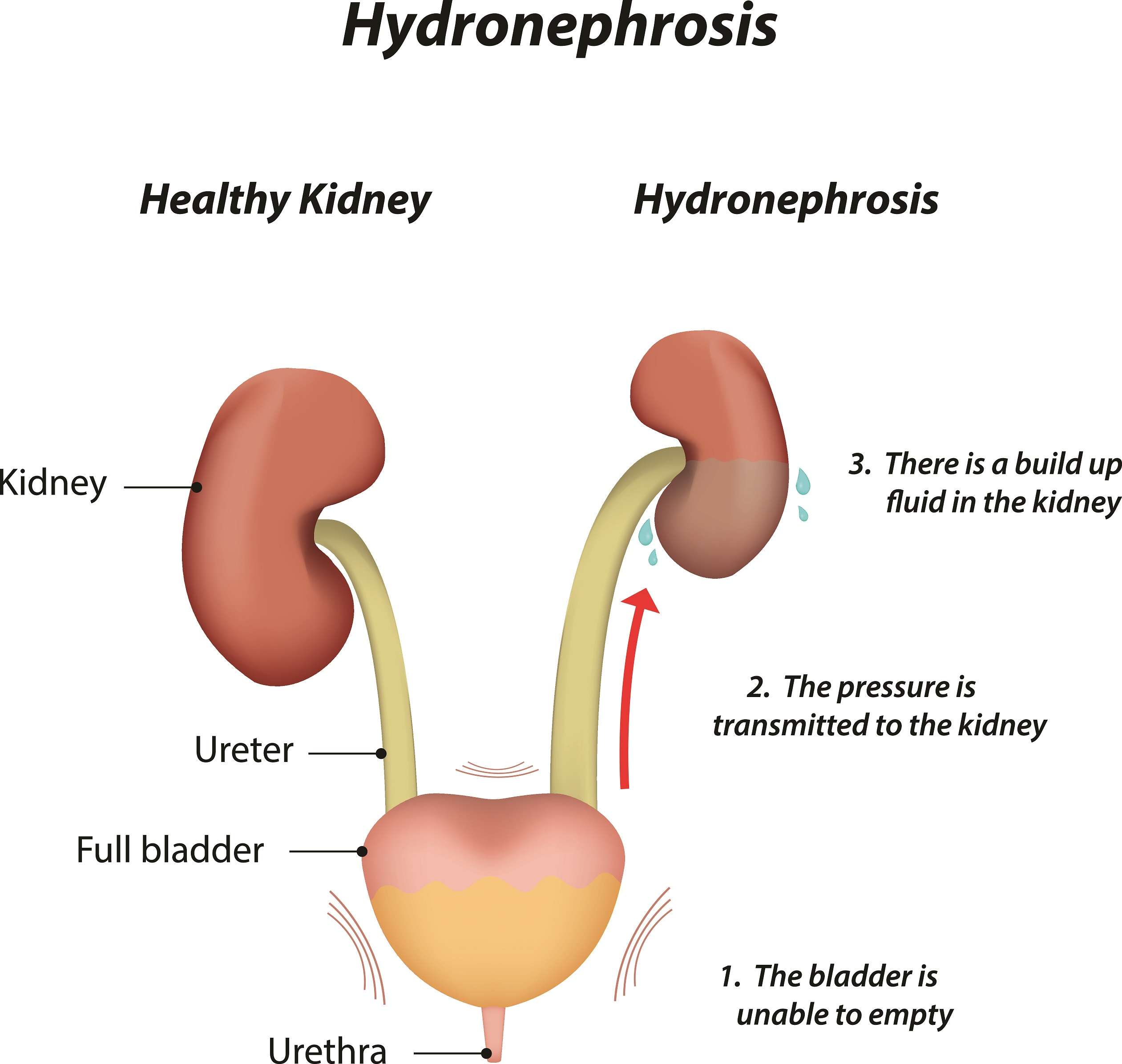 Should I Be Worried That My Unborn Baby Has Hydronephrosis ...