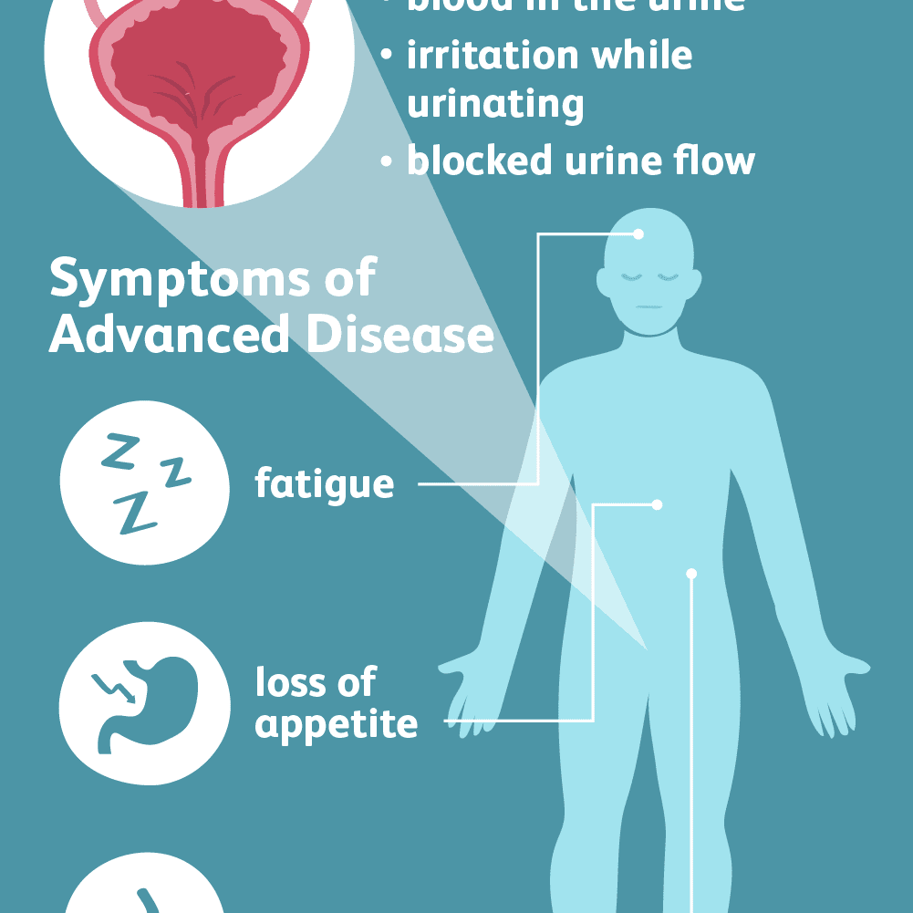 Signs and Symptoms of Bladder Cancer
