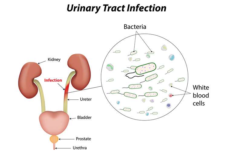 Signs and Symptoms of Urinary Tract Infections (UTIs)