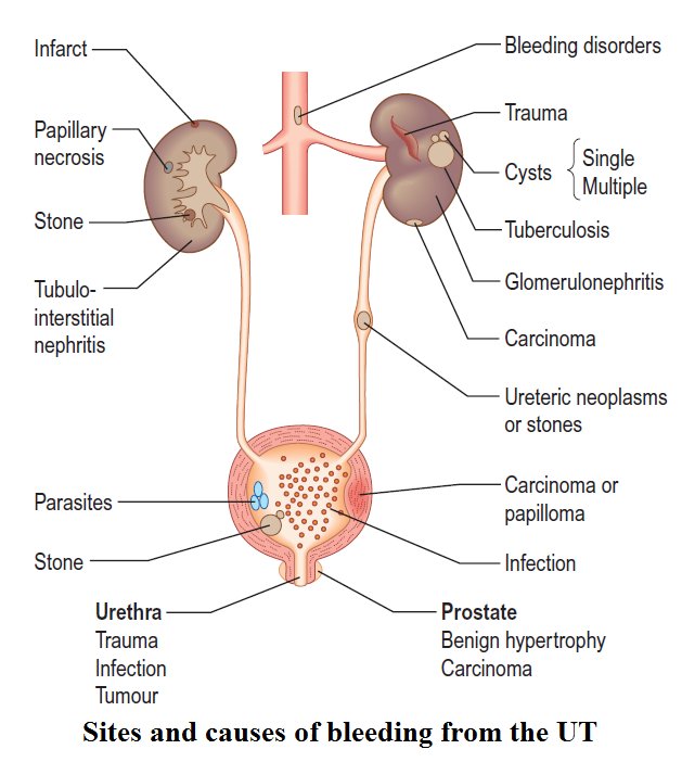 Sites and causes of bleeding from the Urinary Tract ...