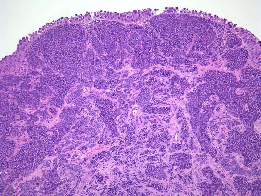 Small Cell Carcinoma of Bladder with overlying Urothelial