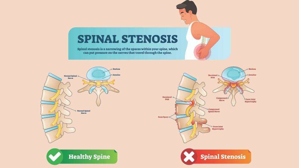 Spinal Stenosis: Symptoms, Diagnosis, and Variations