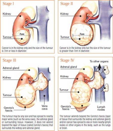 Stage 3 Kidney Cancer Survivors