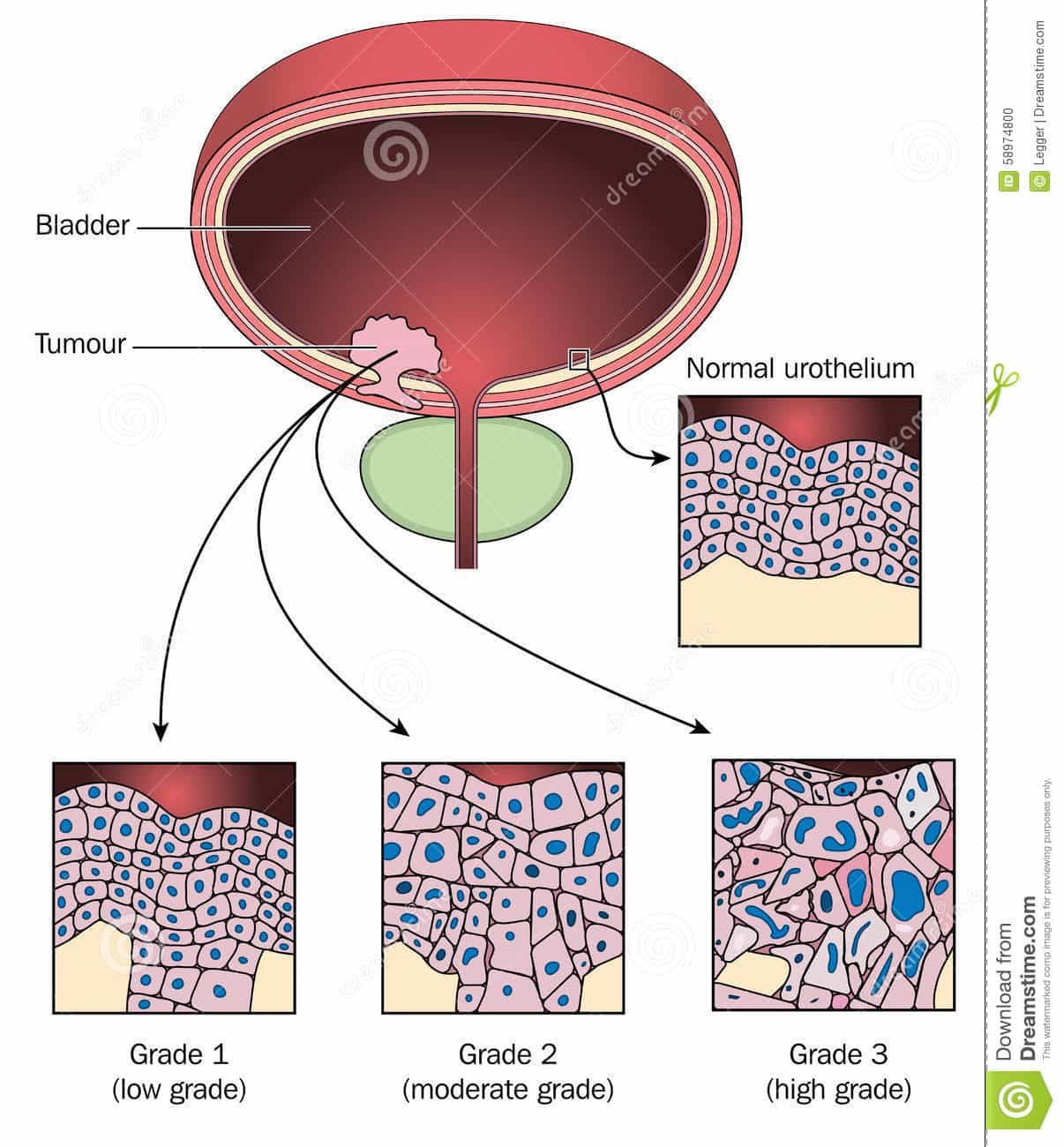 Stages of bladder cancer stock vector. Illustration of medical