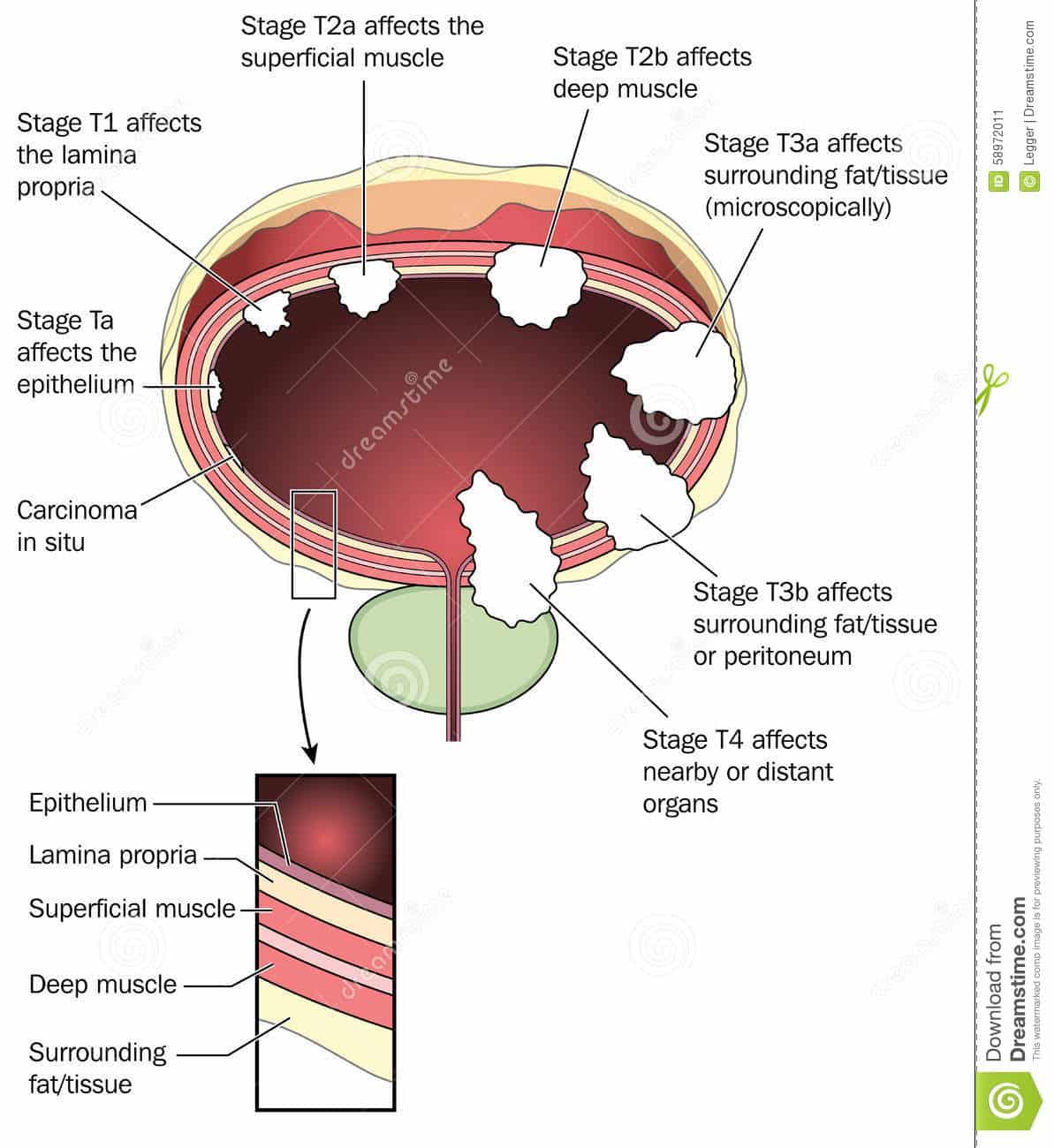 Staging of bladder cancer stock vector. Illustration of cancer
