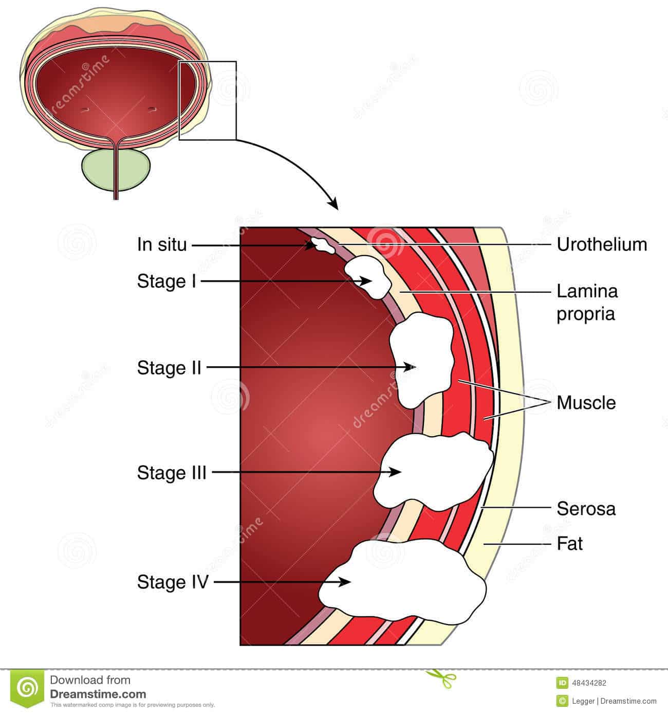 Staging of bladder cancer stock vector. Illustration of tumor