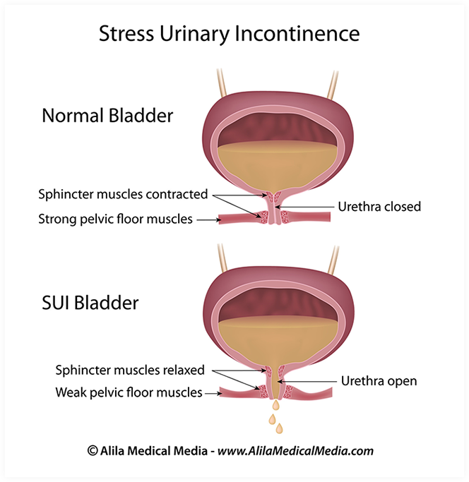 Stress Incontinence NYC