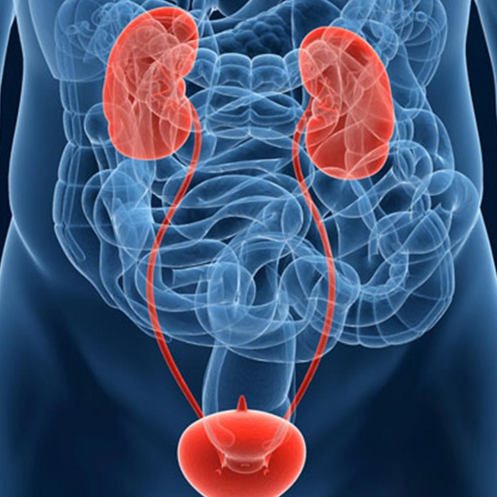Study Investigates Survival Rates of Bladder Cancer Patients ...