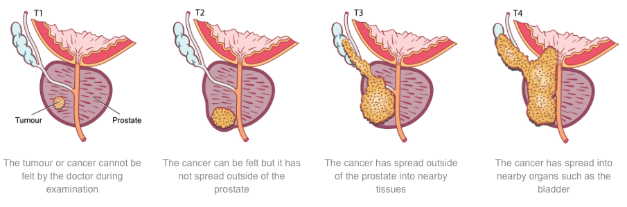 Sunshine Coast Urology Â» What is prostate cancer?