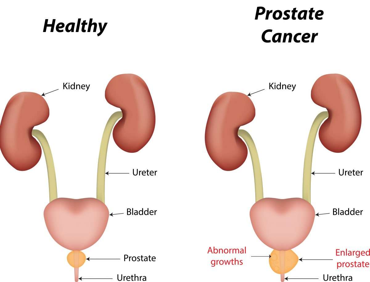Symptom of prostate cancer