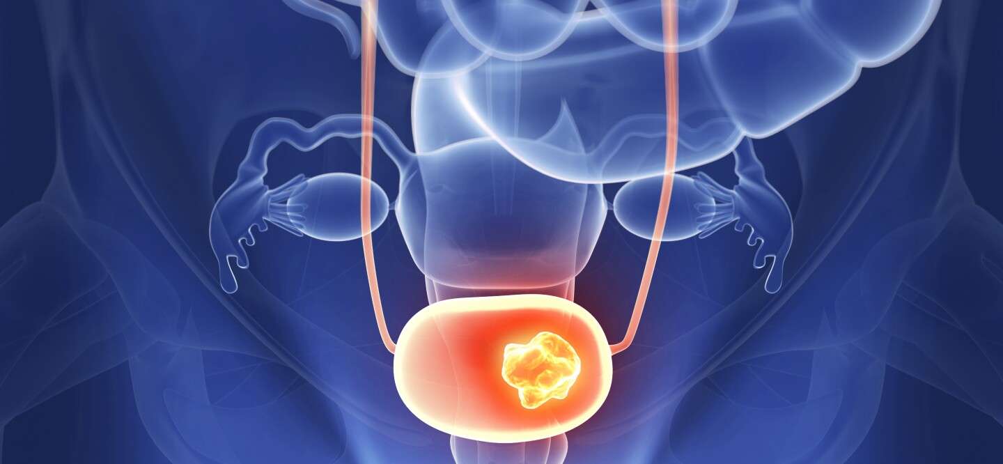 The Fascinating Story Behind a New Bladder Cancer ...