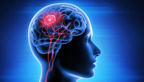 The Most Common Origins of Brain Metastasis Include Primary Cancers of ...