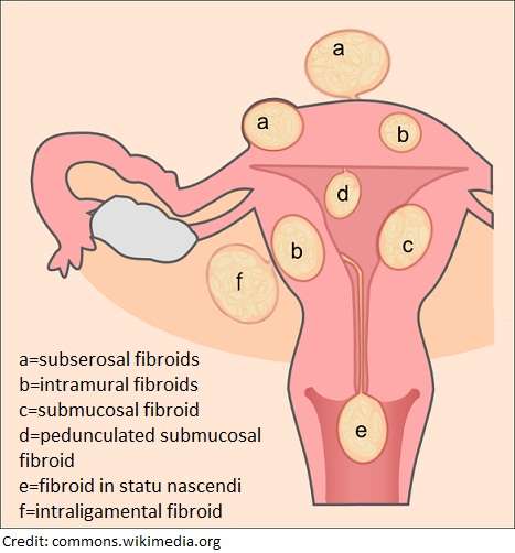 The # One Fibroid Myth You Keep Falling For
