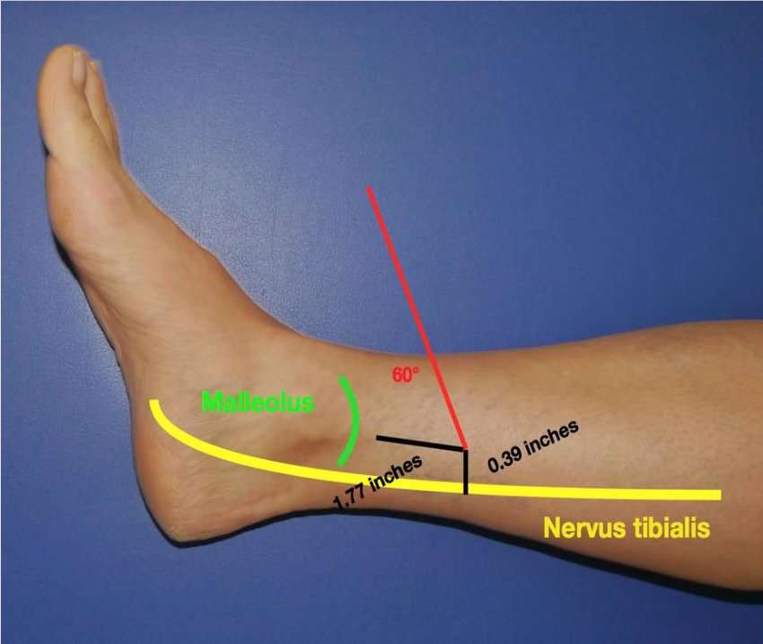 The percutaneous posterior tibial nerve stimulation point