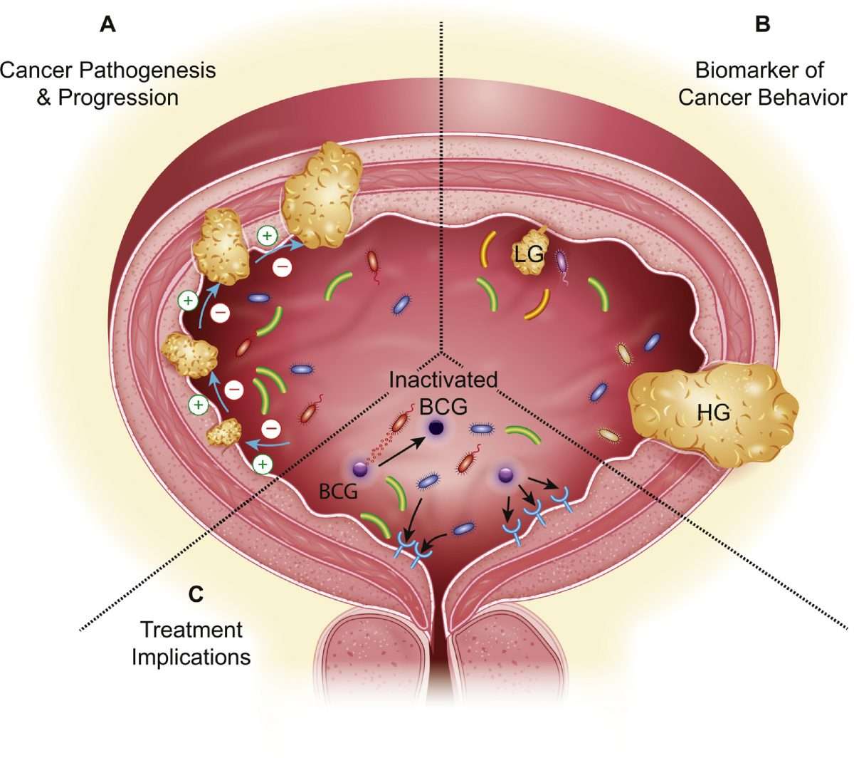 The Urinary Microbiome: Implications in Bladder Cancer Pathogenesis and ...